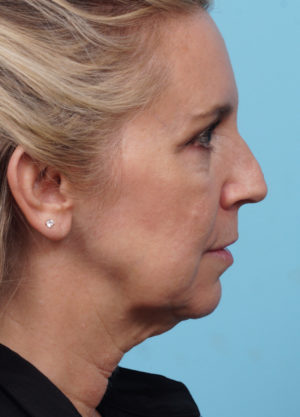 Face Lift/ Mini Lift/ Neck Lift