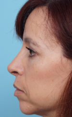 Rhinoplasty