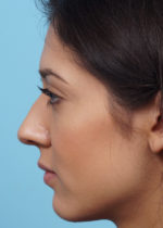 Rhinoplasty