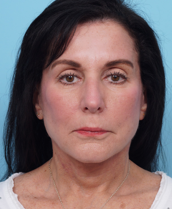 Face Lift/ Mini Lift/ Neck Lift