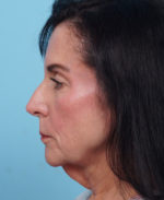 Face Lift/ Mini Lift/ Neck Lift