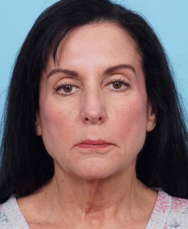 Face Lift/ Mini Lift/ Neck Lift