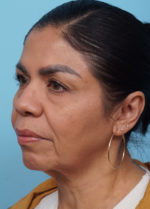 Face Lift/ Neck Lift