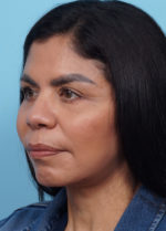 Face Lift/ Neck Lift