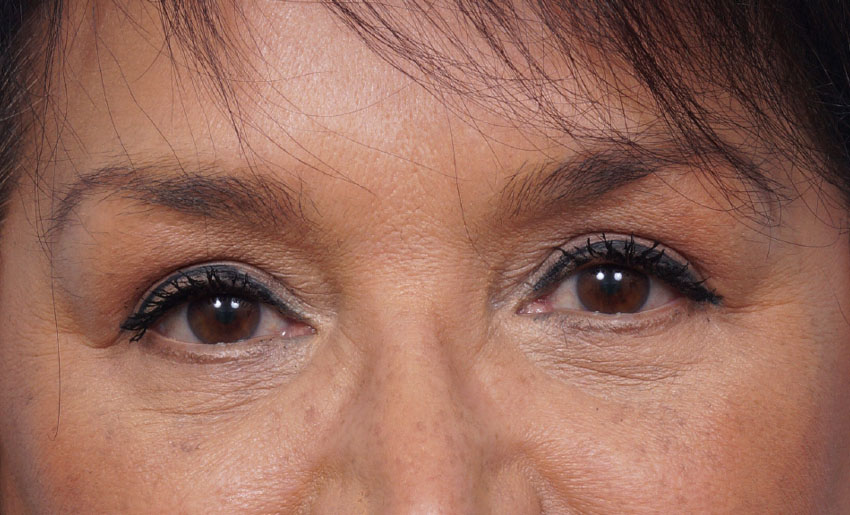 Eye Rejuvenation