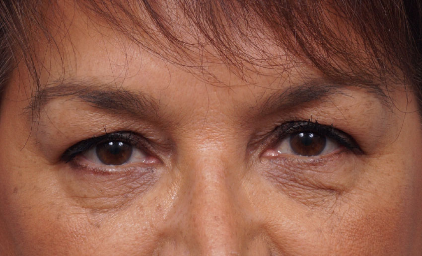 Eye Rejuvenation