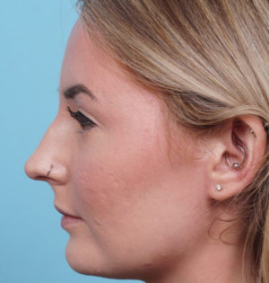 Rhinoplasty