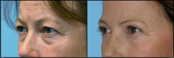eyelid surgery - Eye Rejuvenation