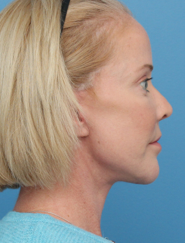 Face Lift/ Mini Lift/ Neck Lift