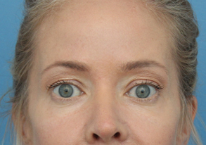 Eye Rejuvenation