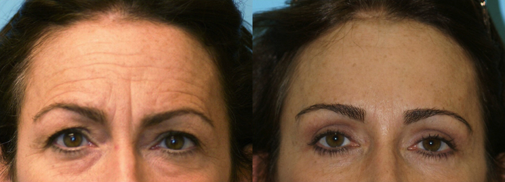 Brow Lift Results San Diego