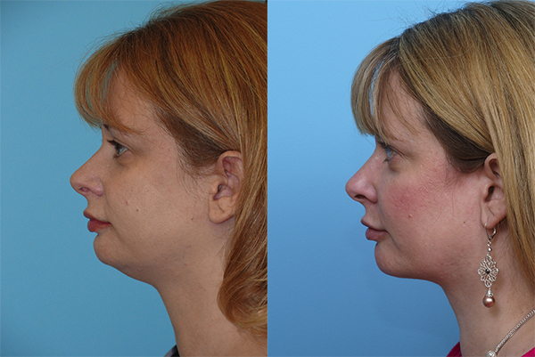 Neck Liposuction Before & After Photos San Diego