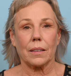 Face Lift/ Neck Lift