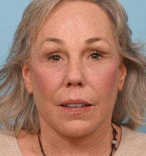 Face Lift/ Neck Lift