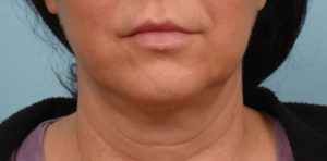 Face Lift/ Mini Lift/ Neck Lift