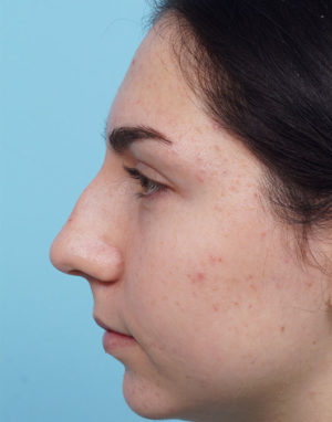 Rhinoplasty