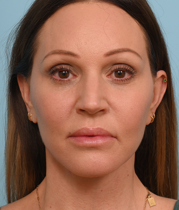 Face Lift/ Mini Lift/ Neck Lift