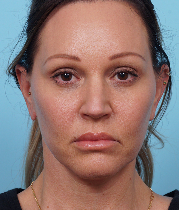 Face Lift/ Mini Lift/ Neck Lift