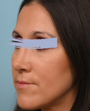 Rhinoplasty