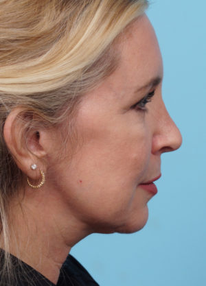 Facial Fat Transfer