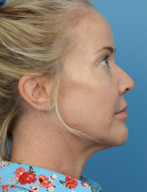 Facial Fat Transfer