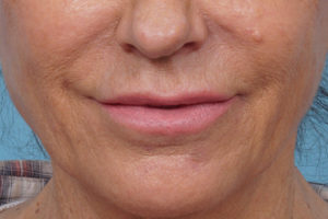 Lip Lift