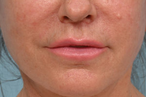 Lip Lift