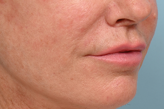 Lip Lift