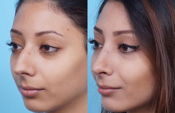 Revision Rhinoplasty before & After