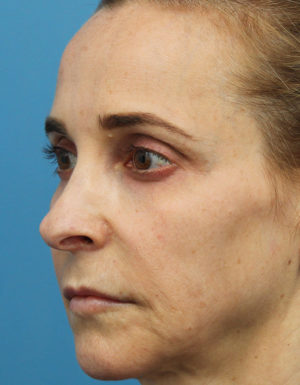 Rhinoplasty