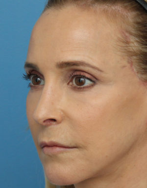 Rhinoplasty