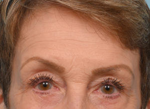 Brow Lift