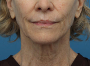 Face Lift/ Neck Lift