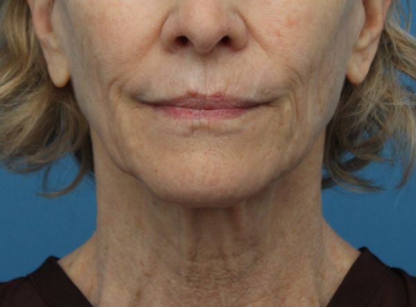 Face Lift/ Neck Lift