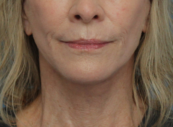 Face Lift/ Neck Lift