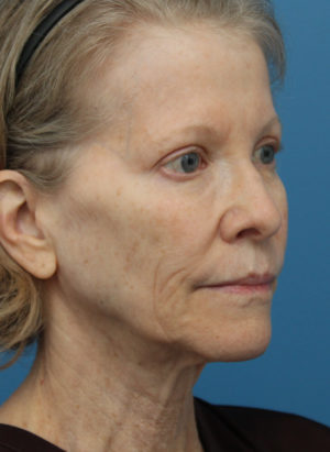 Face Lift/ Neck Lift