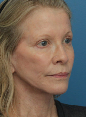 Face Lift/ Neck Lift