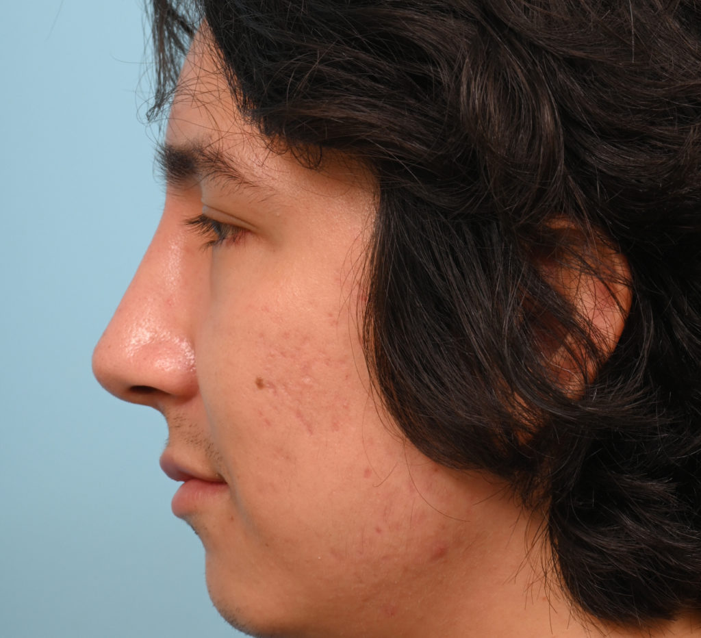 Rhinoplasty