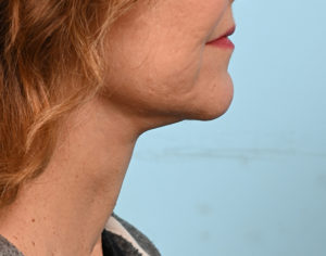 Face Lift/ Mini Lift/ Neck Lift