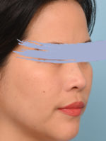 Rhinoplasty