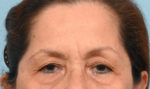 Brow Lift