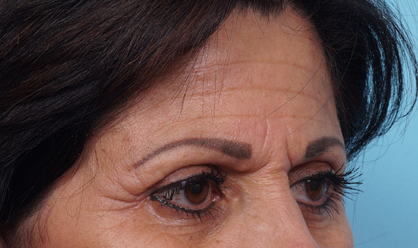 Brow Lift