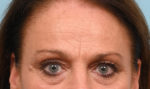 Brow Lift