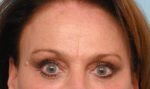 Brow Lift