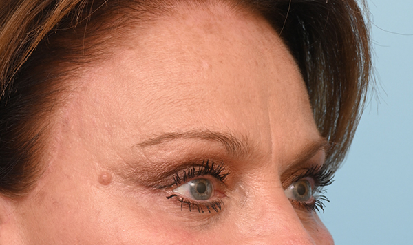 Brow Lift