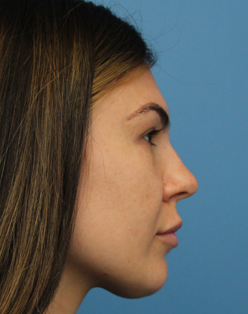 Rhinoplasty