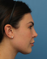 Rhinoplasty