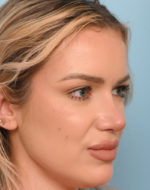 Rhinoplasty