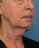 Facial Fat Transfer