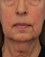 Face Lift/ Mini Lift/ Neck Lift